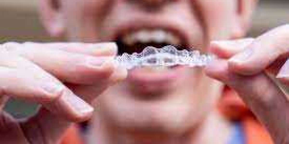 Understanding Composite Bonding in Dentistry