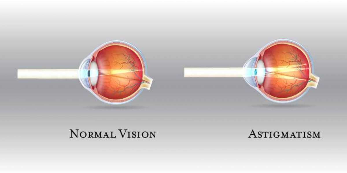 Astigmatism Market: Analysis of Epidemiology, Industry Trends, Size, Share, and Future Forecast (2024-2034)