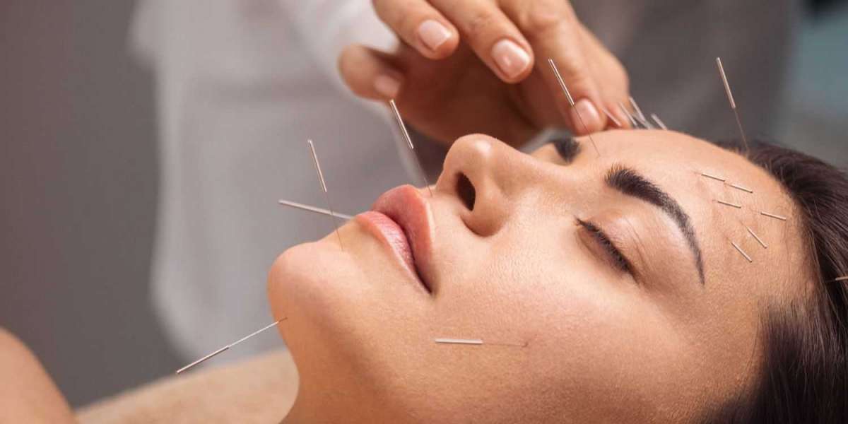 Managing Menopause: The Benefits of Acupuncture