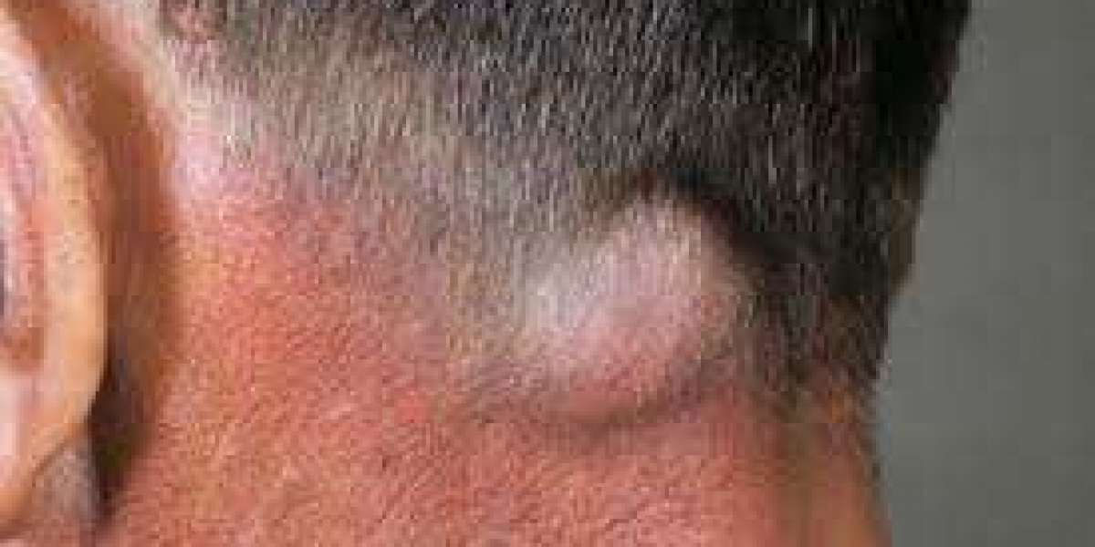 Recurrent Head and Neck Squamous Cell Carcinoma Market Size, Epidemiology, Forecast & Industry Trends 2024-2034