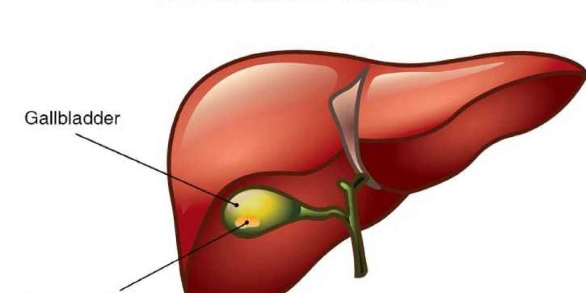 Top-Rated Gallbladder Cancer Surgeon in Guwahati: Choosing the Best Personalized Treatment with Expert Care