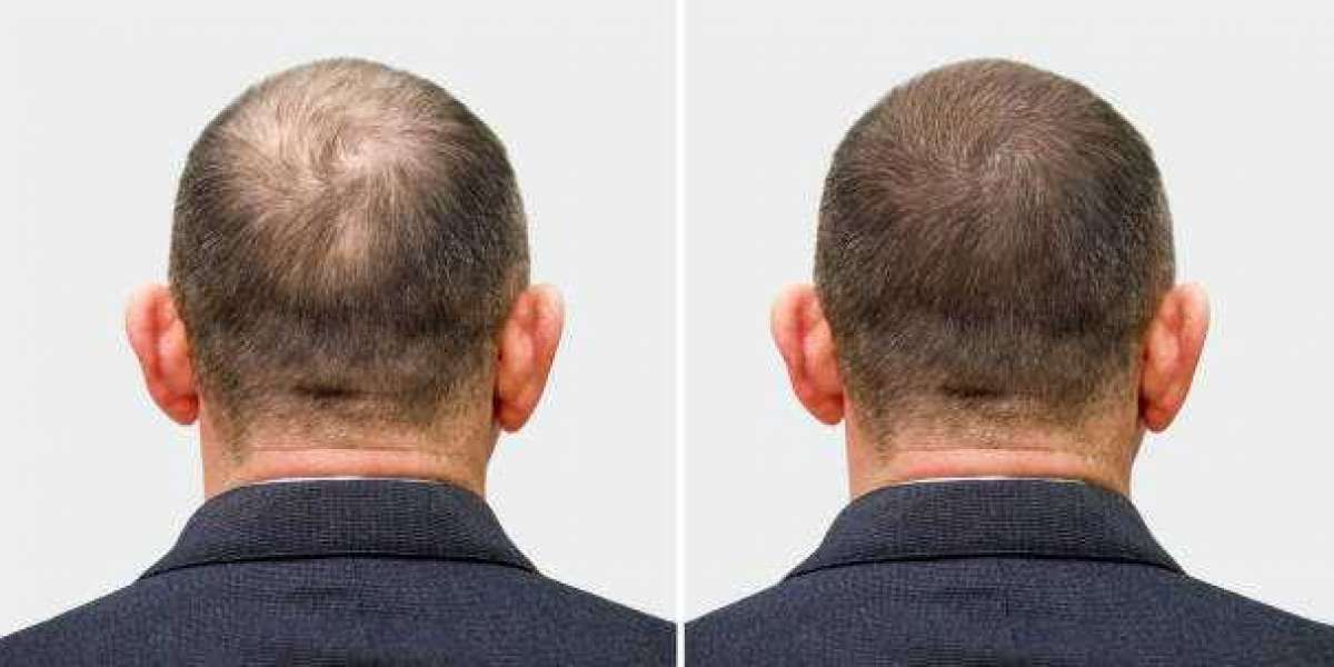 Hair Transplants for Men: Surgeons at This Hair Clinic Will Make You Look Younger