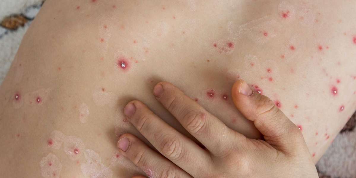 What Are Common Rash Symptoms in Children?