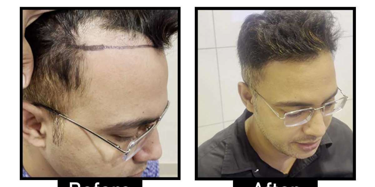 Affordable and Best Hair Transplant in South Delhi: What to Expect