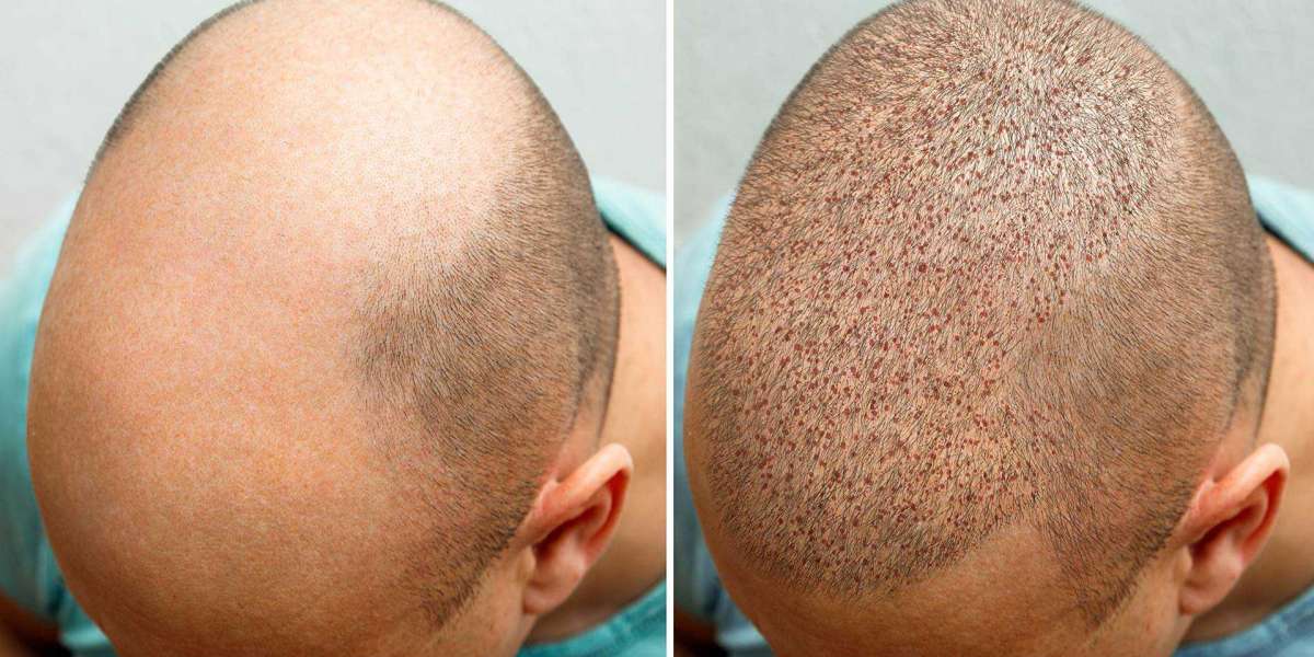 Hair Restoration in Delhi: A Comprehensive Guide to Hair Loss Treatment at AISHH Clinic