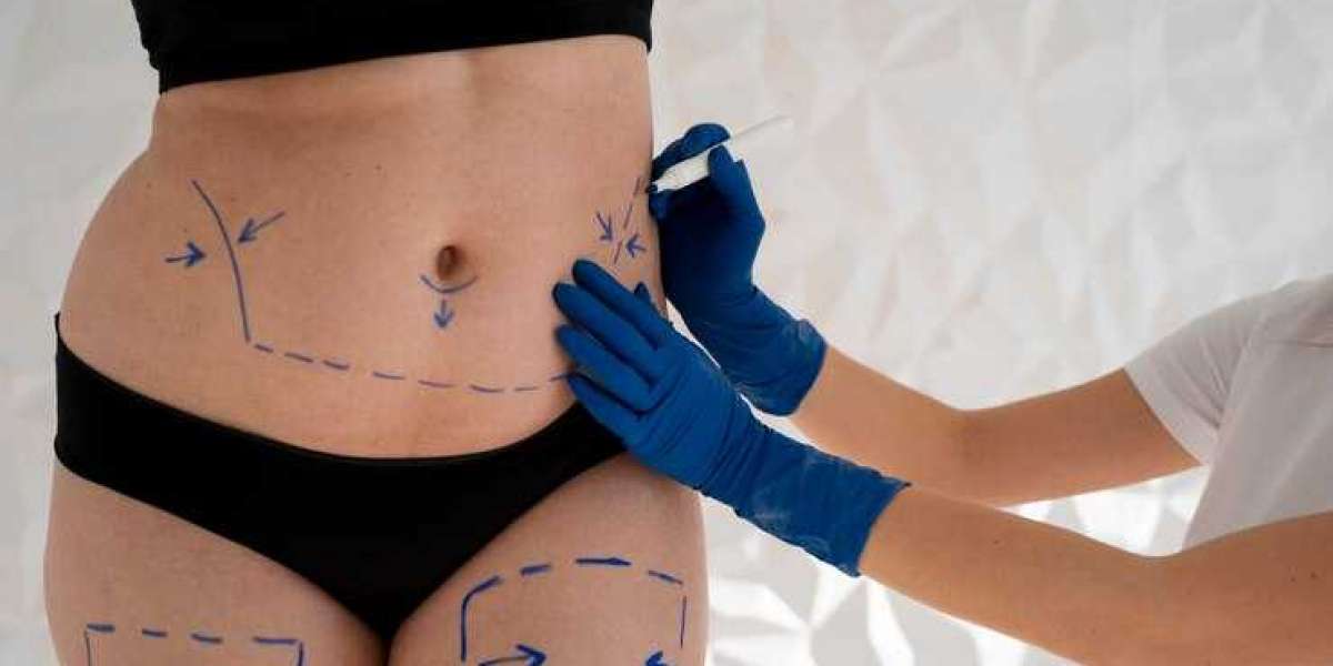 Cost of a Tummy Tuck in NYC: What You Need to Know