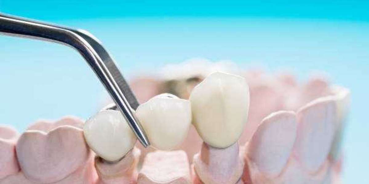 Dental Bridges: A Comprehensive Guide to Restoring Your Smile