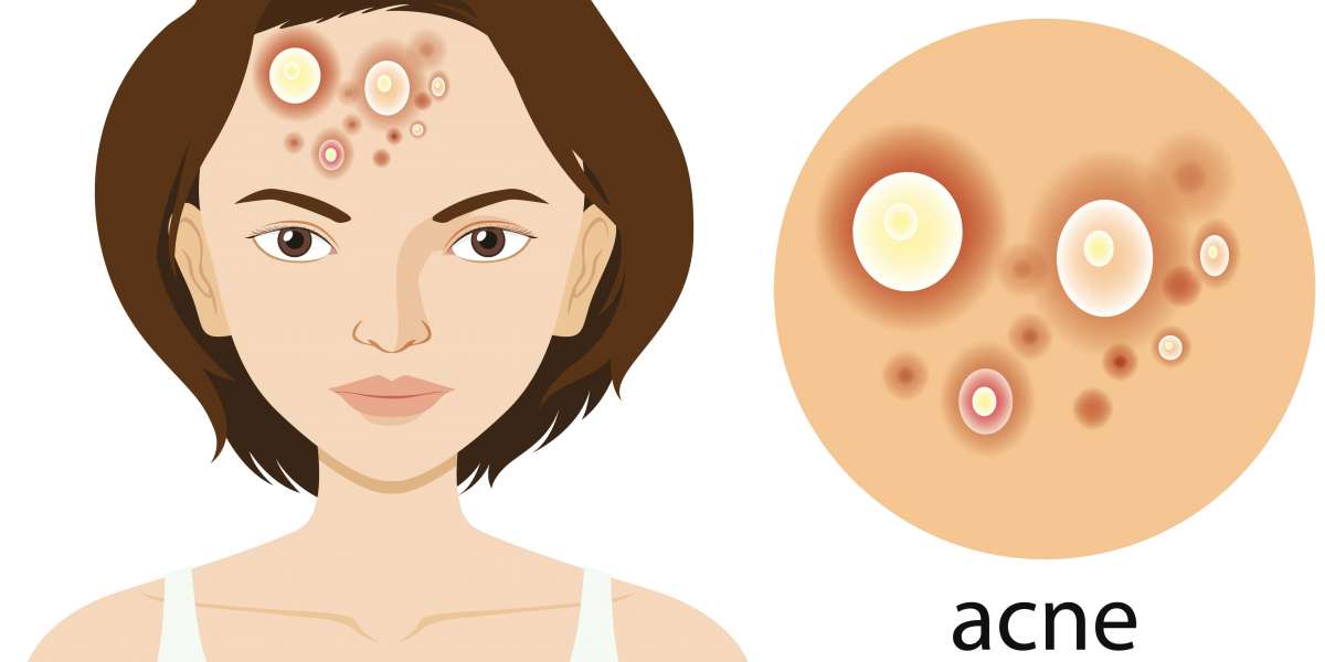 Homeopathic Cream for Acne: Heal Naturally with Dharma Homoeopathy