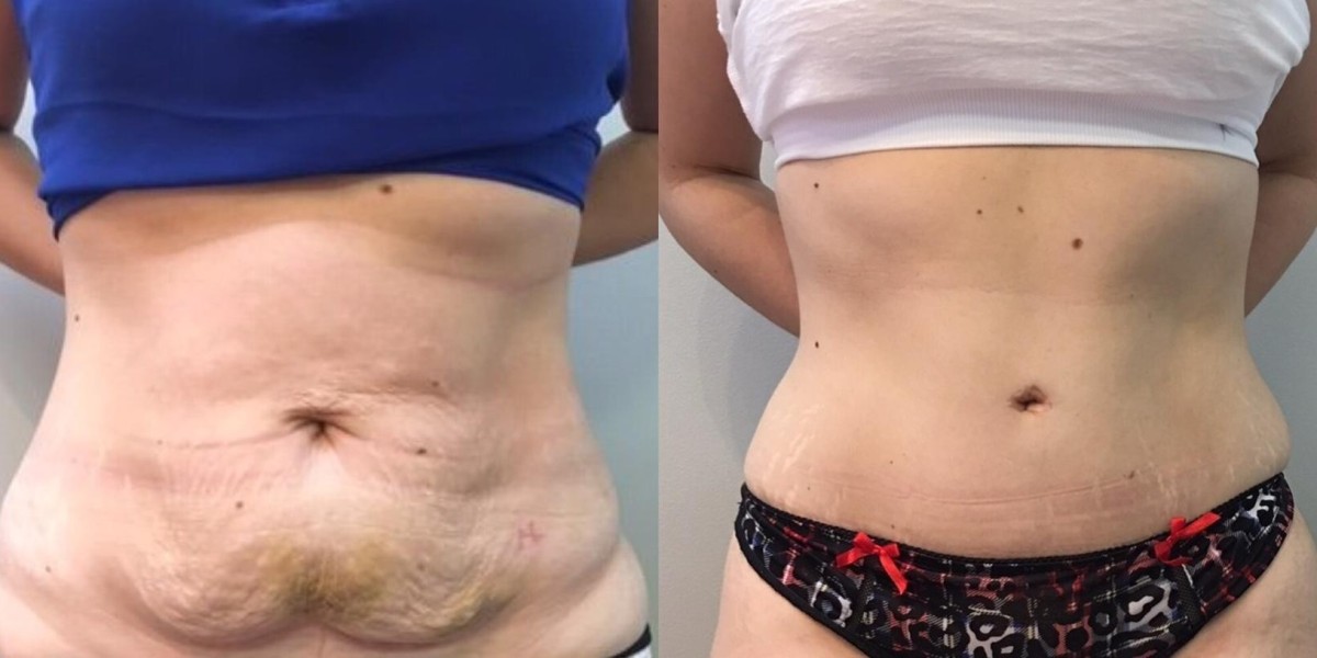 Transform Your Body with a Tummy Tuck in Raleigh, NC