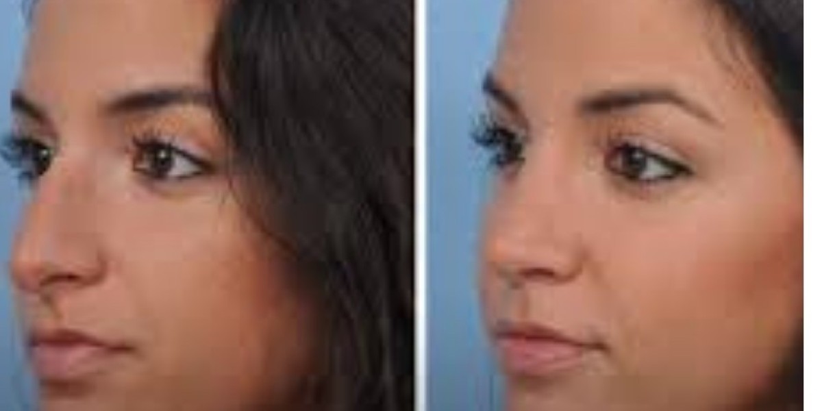 Best Nose Job Surgeon in Chicago: Finding the Right Expert for Rhinoplasty