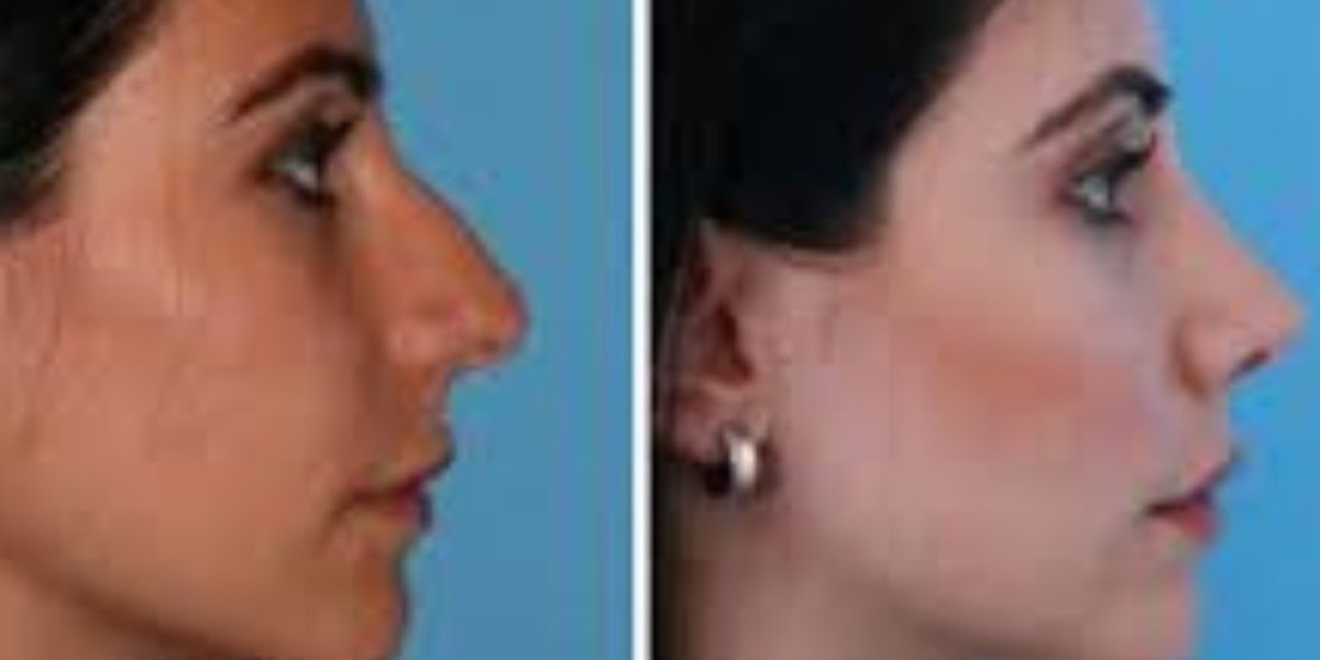 nose surgery chicago il nose surgery chicago il