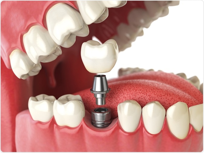 The Step-by-Step Process of Getting Dental Implants – Telegraph