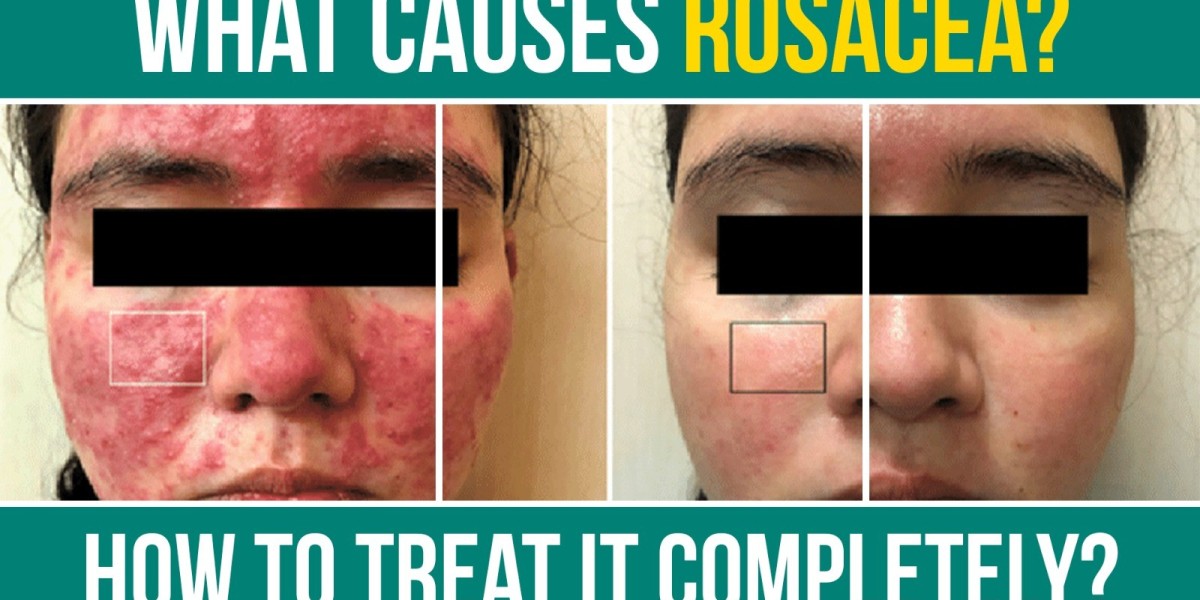 Rosacea Causes and Best Treatment Guide for Clear Skin