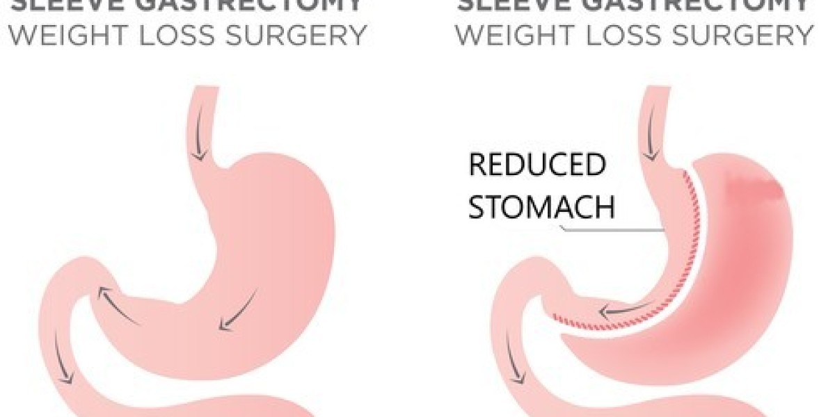 Types of Bariatric Surgery Available in India: Which One Is Right for You?